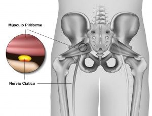 Sindrome-Piriforme-musculo