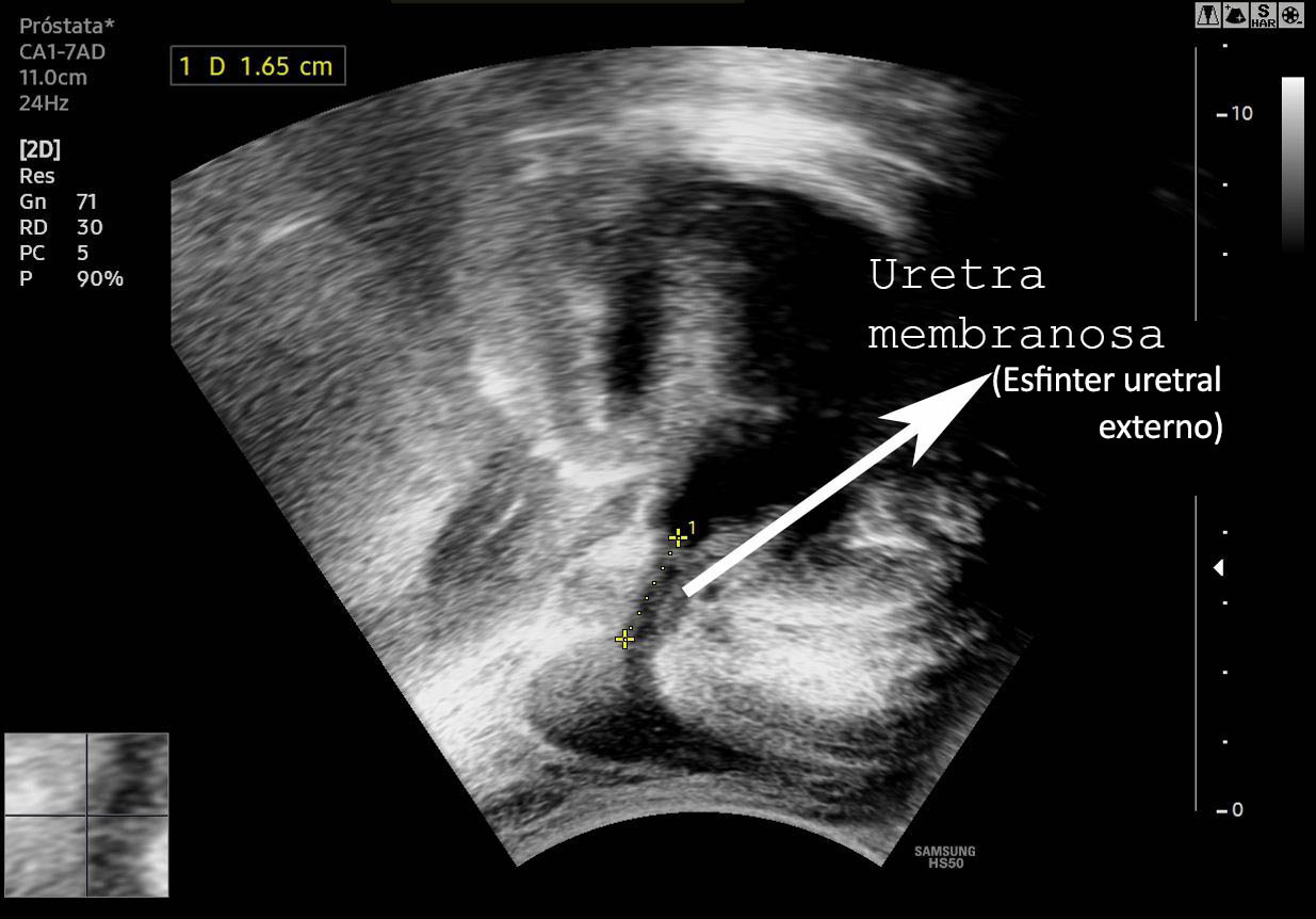 Suelo pélvico hombres fisioterapia elena miralles